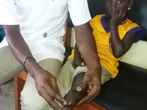 Una gamba nuova per Jennifer - Aidworld in Ghana